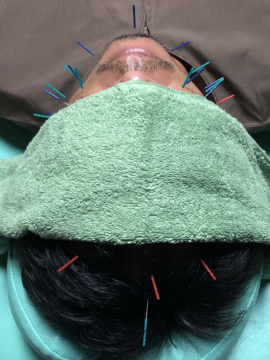 美顔鍼 - 野田市で鍼灸・訪問マッサージをお探しなら関根鍼灸院